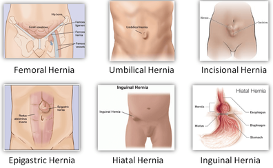Common Types of Hernia repair at Melbourne Hernia Centre by Mr Steven Karametos 